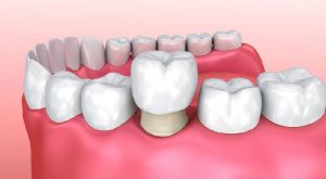 Bọc răng hàm và những điều cần biết trước khi thực hiện