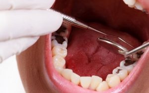 Giải đáp bọc răng sâu bao nhiêu tiền? Các yếu tố ảnh hưởng
