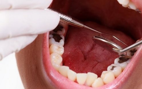 Giải đáp bọc răng sâu bao nhiêu tiền? Các yếu tố ảnh hưởng