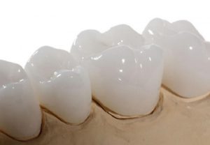 Giải đáp bọc răng sứ Venus giá bao nhiêu? Những lưu ý khi thực hiện