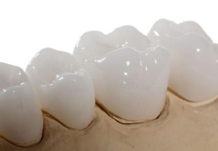 Giải đáp bọc răng sứ Venus giá bao nhiêu? Những lưu ý khi thực hiện