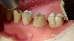 bọc răng sứ không cần mài răng