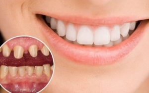 Giải đáp thắc mắc bọc răng sứ nguyên hàm giá bao nhiêu hiện nay?