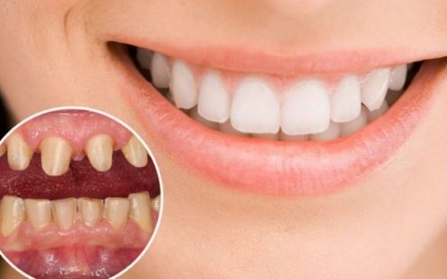 Giải đáp thắc mắc bọc răng sứ nguyên hàm giá bao nhiêu hiện nay?