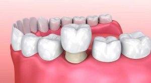 Bọc răng sứ, phương pháp phục hồi răng thẩm mỹ hiệu quả