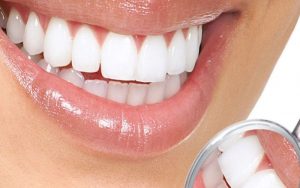 Khi nào nên bọc răng sứ