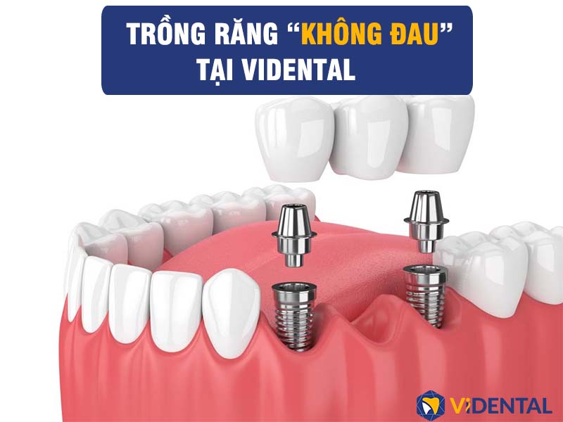 Trồng răng Implant là một trong những dịch vụ nổi bật tại Viện Nha khoa ViDental