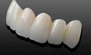 Bọc răng sứ cercon giá bao nhiêu, nên bọc loại nào và bọc ở đâu?