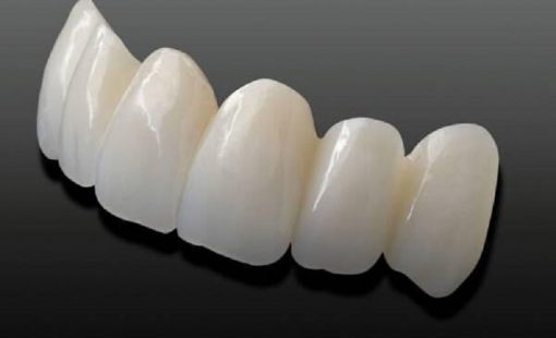Bọc răng sứ cercon giá bao nhiêu, nên bọc loại nào và bọc ở đâu?