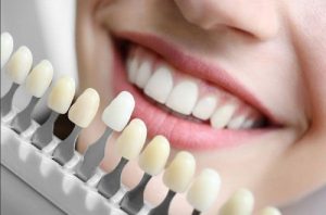 Bọc răng sứ titan có tốt không, nên thực hiện ở đâu hiệu quả?