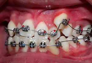 Răng khấp khểnh: Nguyên nhân, cách điều trị và địa chỉ thực hiện
