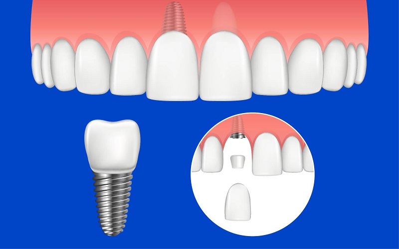 Trồng răng sứ được áp dụng trong một số trường hợp