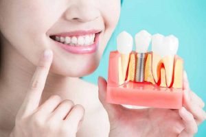 Trồng răng sứ giá bao nhiêu 1 chiếc [Bảng giá mới nhất]
