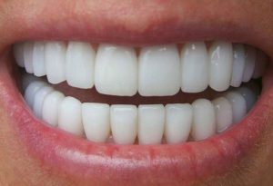 Trồng răng sứ nguyên hàm - 6 điều cần biết trước khi thực hiện