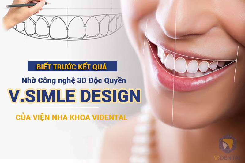 Công nghệ Thiết kế nụ cười V.Smile Design tại ViDental
