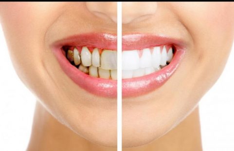 Tẩy trắng răng Hà Nội