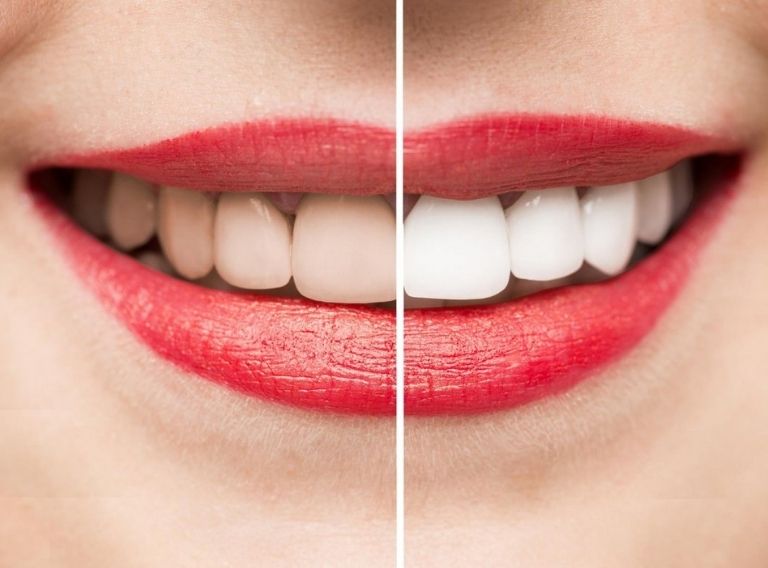 Đánh giá của khách hàng cũng là yếu tố quyết định lựa chọn địa chỉ làm sáng răng