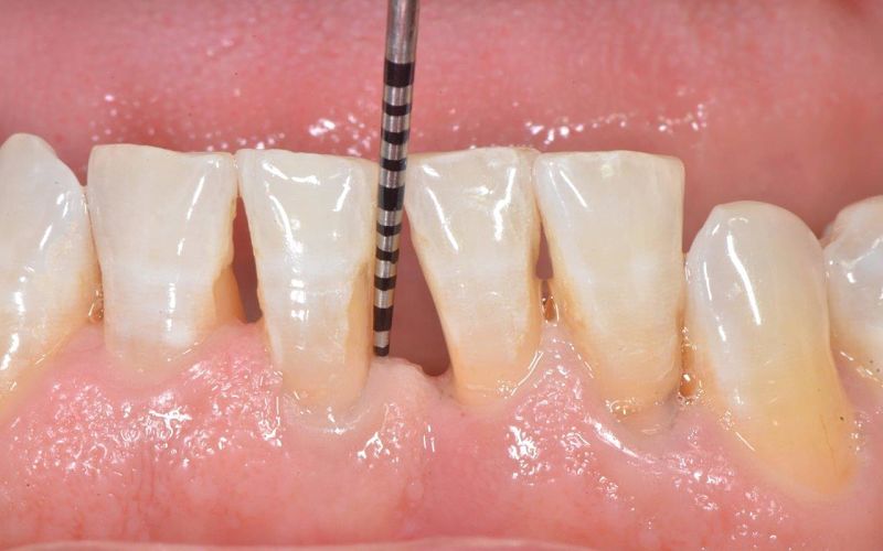 Răng thưa gây mất thẩm mỹ và khó khăn trong việc ăn uống