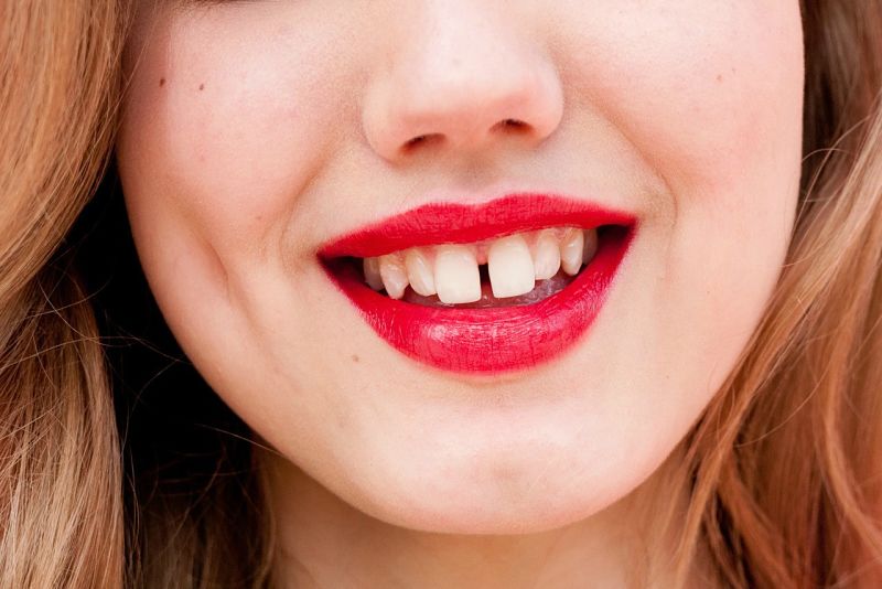 Niềng răng thưa giúp bạn sở hữu hàm răng khỏe mạnh, đều đẹp