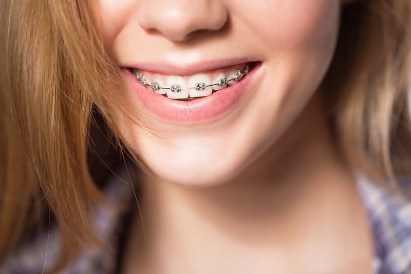 Có rất nhiều phương pháp niềng răng hiện nay
