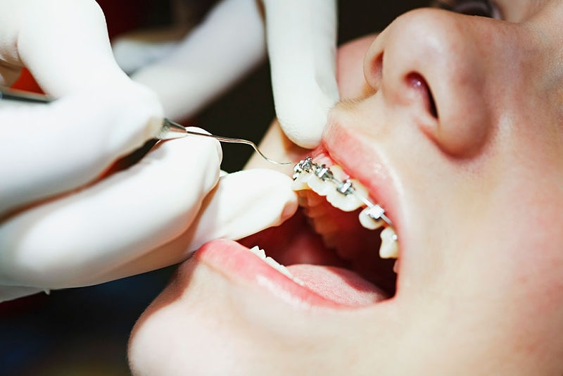 Niềng răng thưa cần trải qua các bước đúng quy trình
