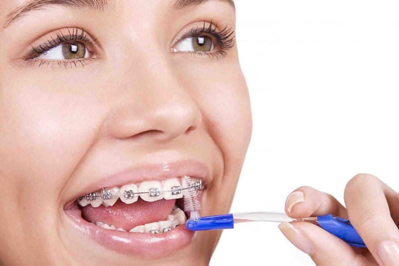 Chú ý vệ sinh răng sạch sẽ trong quá trình thực hiện