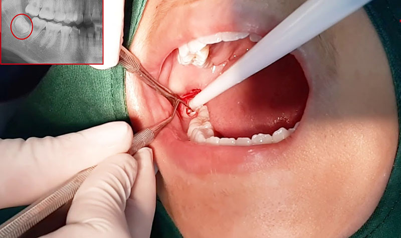 Sau khi gây tê, bác sĩ sẽ tiến hành rạch mở lợi để làm bộc lộ thân răng