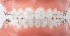 niềng răng mắc cài sứ tự buộc