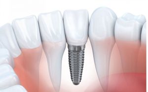 [Tìm Hiểu] Trồng Răng Implant Giá Rẻ Ở Tại TPHCM Có Tốt Không?