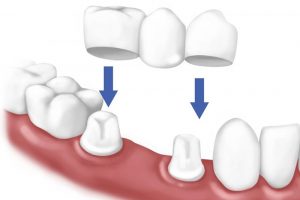 Trồng Răng Giả Cố Định Là Gì? Phương Pháp Và Địa Chỉ Thực Hiện Uy Tín