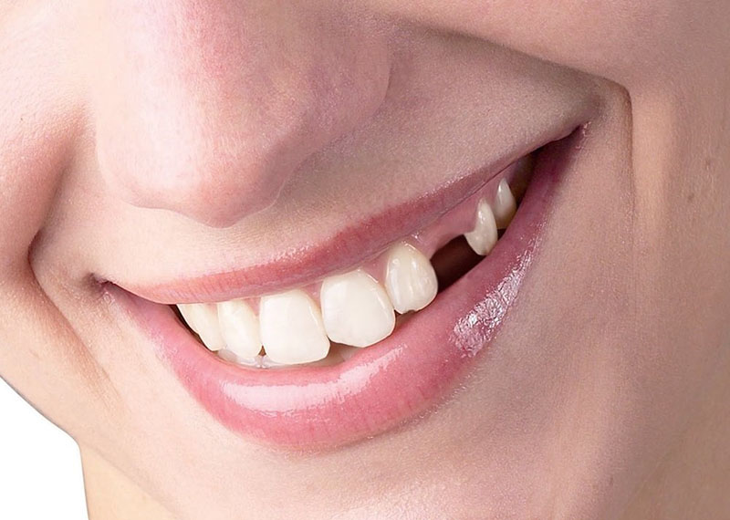Lưu ý khi trồng răng nanh để tiết kiệm chi phí và đảm bảo hiệu quả