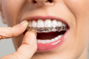 [Tư Vấn] Thông Tin Chi Tiết Về Bảng Giá Niềng Răng Trong Suốt