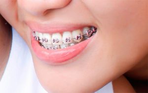 Giá Niềng Răng Mắc Cài Theo Từng Phương Pháp Phổ Biến