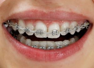 Thông tin chi tiết về giá niềng răng mắc cài kim loại thường