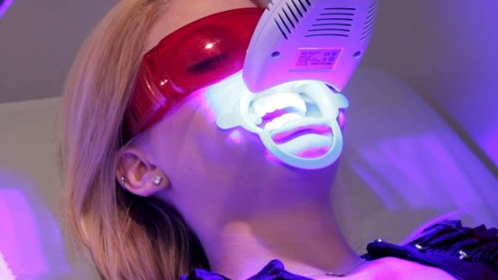 Tẩy Trắng Răng Xong Bị Vàng Lại Không Và Nguyên Nhân Từ Đâu