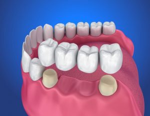 Trồng Răng Bắc Cầu: Quy Trình Và Những Lưu Ý Quan Trọng