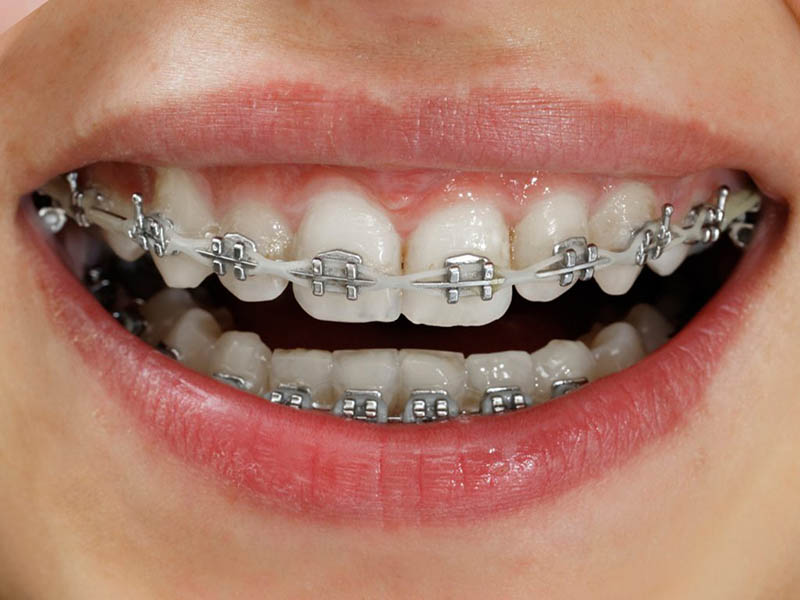 Niềng răng mắc cài kim loại là phương pháp chỉnh nha nhiều người lựa chọn