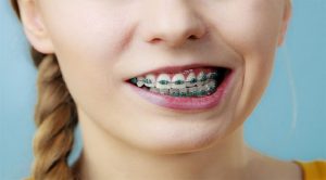 Niềng Răng Bị Lệch Mặt: Nguyên Nhân Và Giải Pháp Khắc Phục