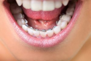 Chỉ Niềng Răng Hàm Dưới Có Mang Đến Hiệu Quả? Lưu Ý Khi Thực Hiện
