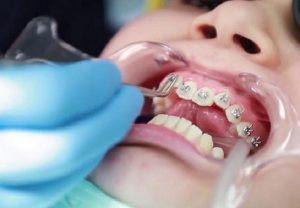 Khi Nào Nên Lựa Chọn Niềng Răng Hàm Trên? Lưu Ý Khi Thực Hiện