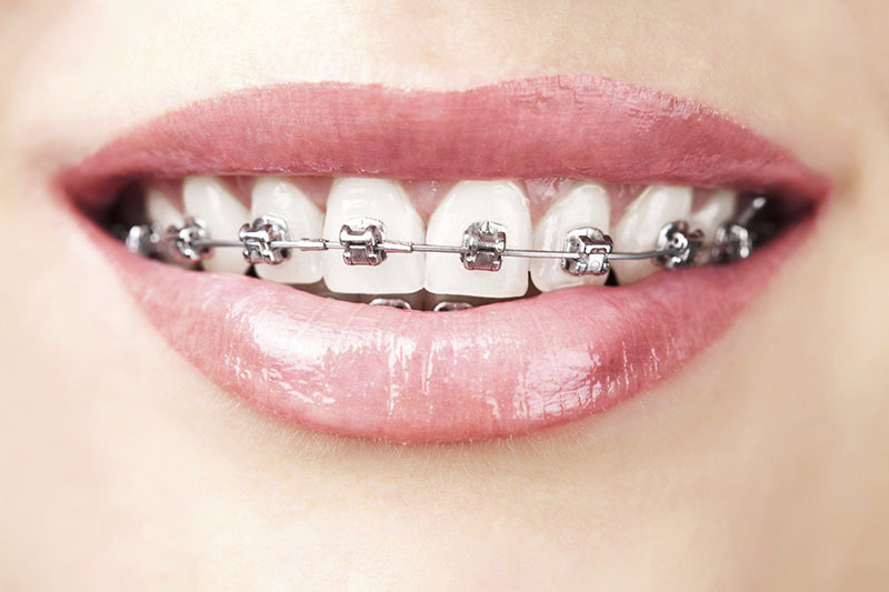 Niềng răng mắc cài kim loại tự đóng là lựa chọn của nhiều người