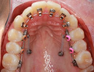[Giải Đáp] Niềng Răng Mặt Trong Và Những Điều Cần Biết