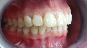 Niềng Răng Vẩu Và 5 Thắc Mắc Thường Gặp
