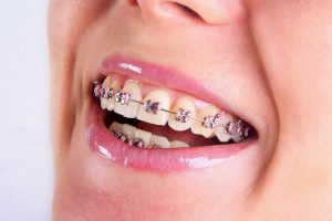 Khách hàng sẽ được tư vấn chi tiết phương pháp chỉnh nha phù hợp
