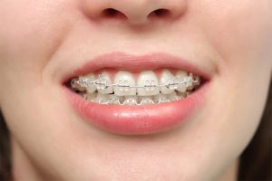 Niềng Răng Có Ảnh Hưởng Gì Không Và Một Số Lưu Ý Quan Trọng