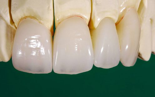 Răng Sứ Zolid Là Gì Và Một Số Thông Tin Bạn Cần Biết