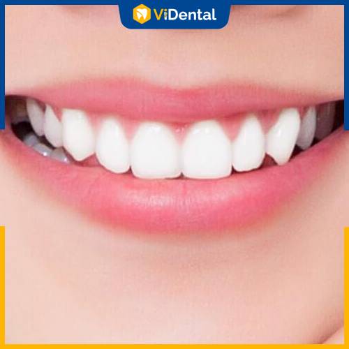 Bọc răng sứ là phương pháp làm đẹp răng được ưa chuộng hiện nay