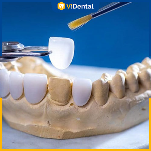 Tùy trường hợp mà lựa chọn dán sứ hoặc bọc răng sứ