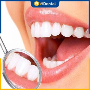 Bọc răng sứ và dán sứ mang lại tính thẩm mỹ cao