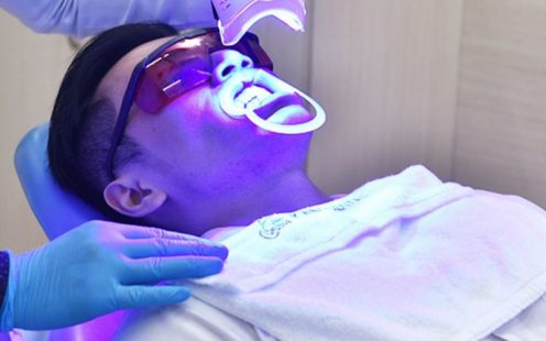 [Chi tiết] Top 10 Địa Chỉ Tẩy Trắng Răng Nha Trang Chất Lượng Nhất